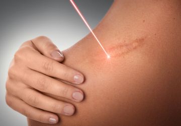 Opracowanie laserowe blizn